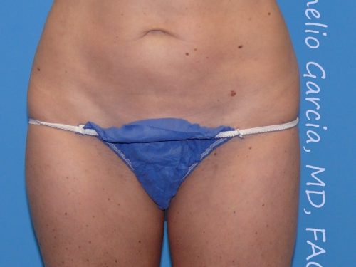 after front view vaser lipo of female patient 3139