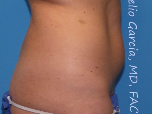 before right side view vaser lipo of female patient 3148