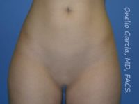 before front view vaser lipo of female patient 3148