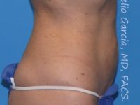 after right side view vaser lipo of female patient 3148
