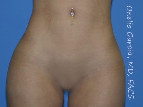 after front view vaser lipo of female patient 3148