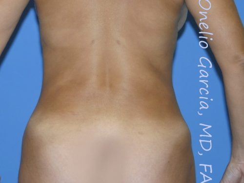 after back view vaser lipo of female patient 3155