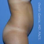before left side view vaser lipo of female patient 3165