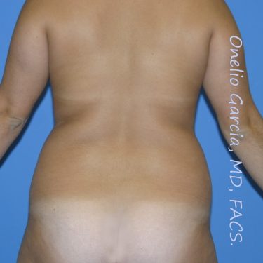 before back view vaser lipo of female patient 3165