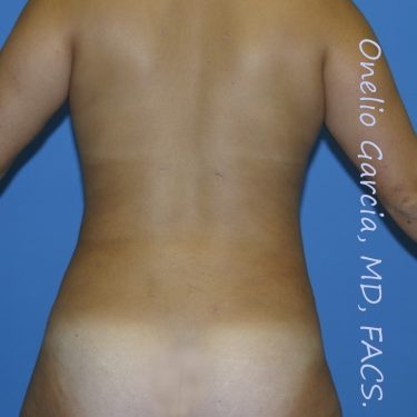 after back view vaser lipo of female patient 3165