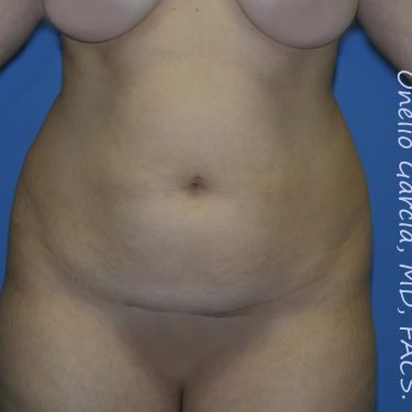 before front view vaser lipo of female patient 3172