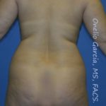 before back view vaser lipo of female patient 3172