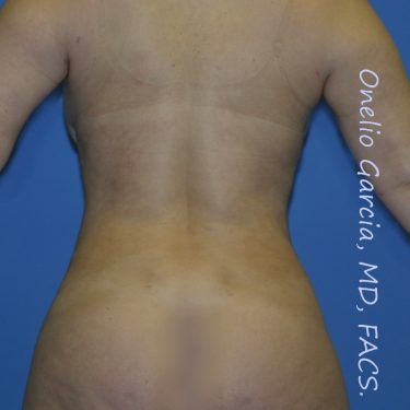after back view vaser lipo of female patient 3172
