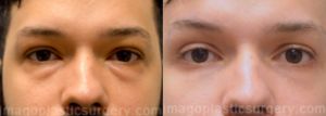 Before and after eyelid surgery Imagos Plastic Surgery
