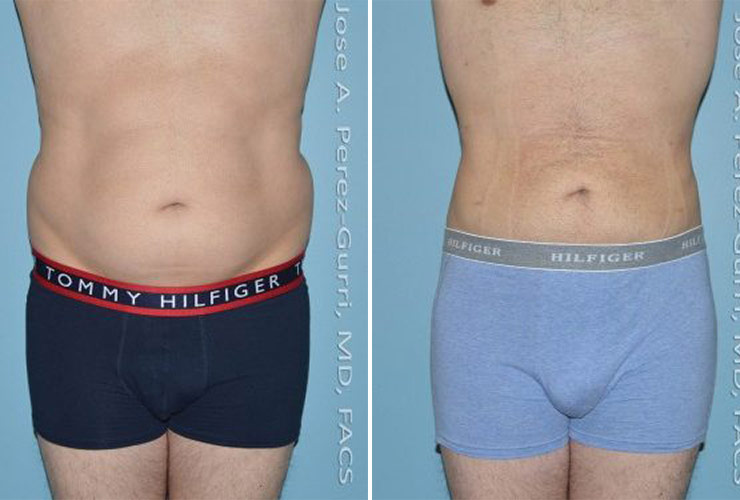 Before and after male liposuction front view Imagos Plastic Surgery