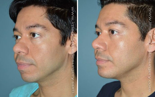 Before and after male rhinoplasty left angle view Imagos Plastic Surgery
