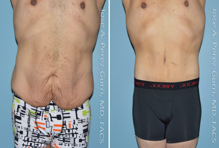 Before and after male tummy tuck front view Imagos Plastic Surgery