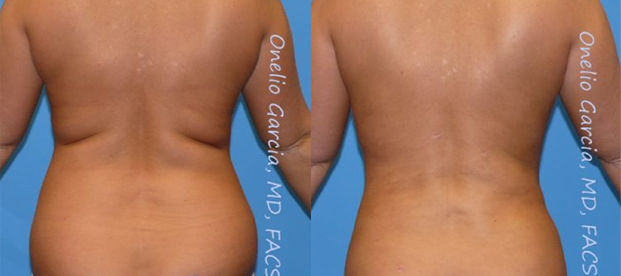 Before and after vaserlipo back view female patient
