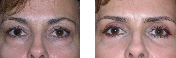 Before and after eyelid surgery female patient Imagos Plastic Surgery