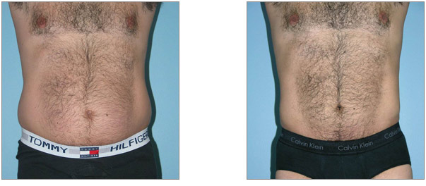 Before and after liposuction male patient front view