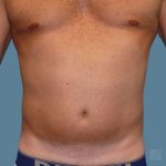 before vaser lipo stomach front view male case 3