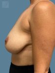 before breast lift side view case 10458