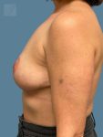 after breast lift side view case 10458