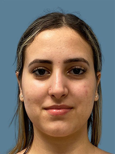 after rhinoplasty front view female case 10451
