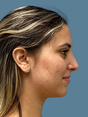 after rhinoplasty side view female case 10455