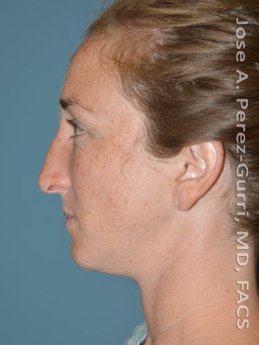 before rhinoplasty left side view female case 9352