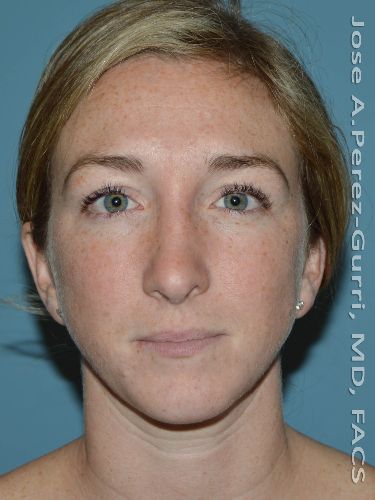 after rhinoplasty front view female case 9352