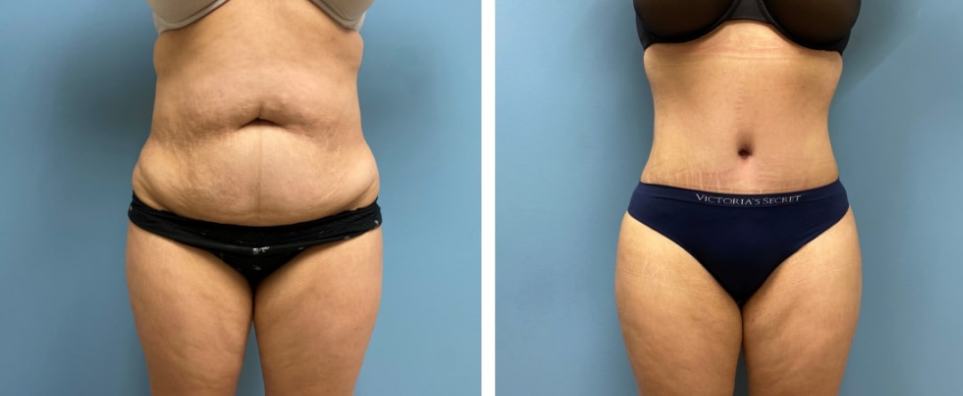 What Does a Tummy Tuck Cost in Tampa, Florida?