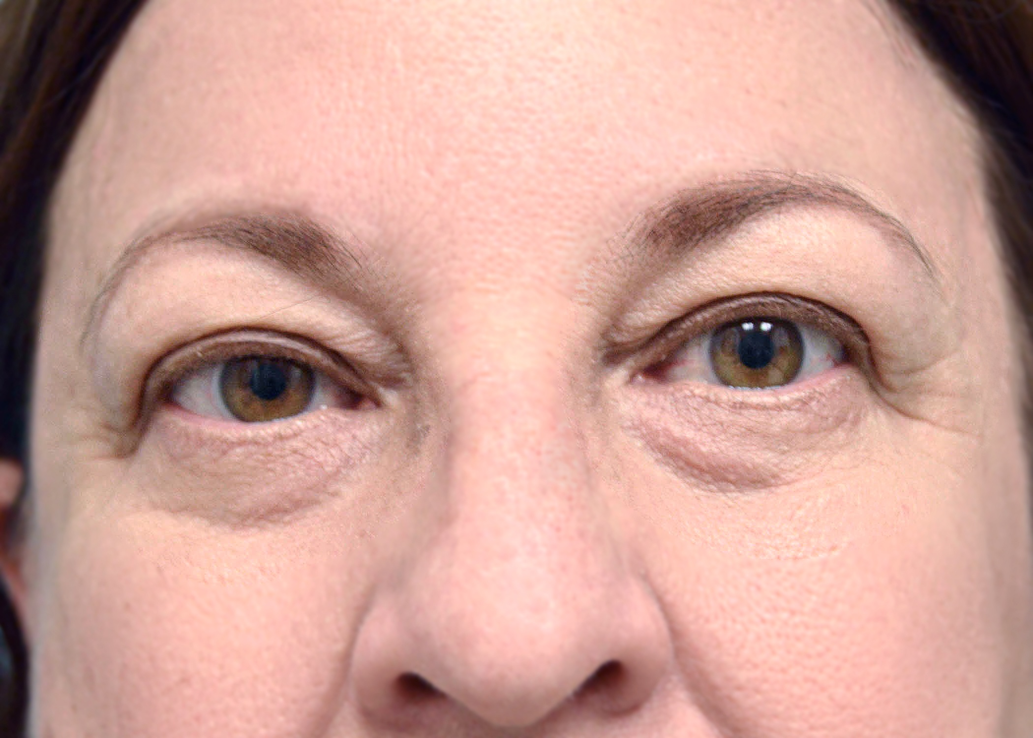 4 eyelid surgery miami