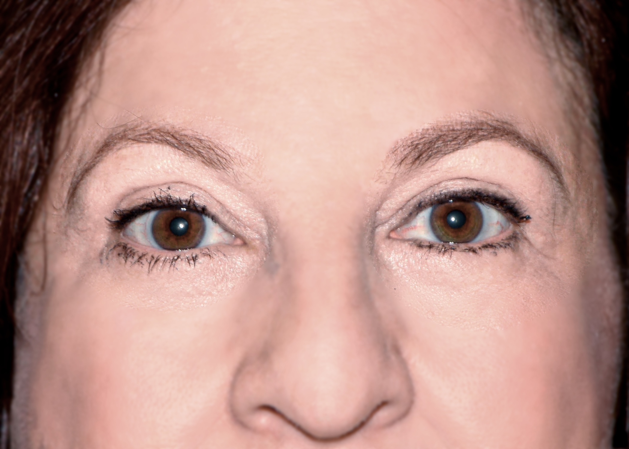 4.1 eyelid surgery miami