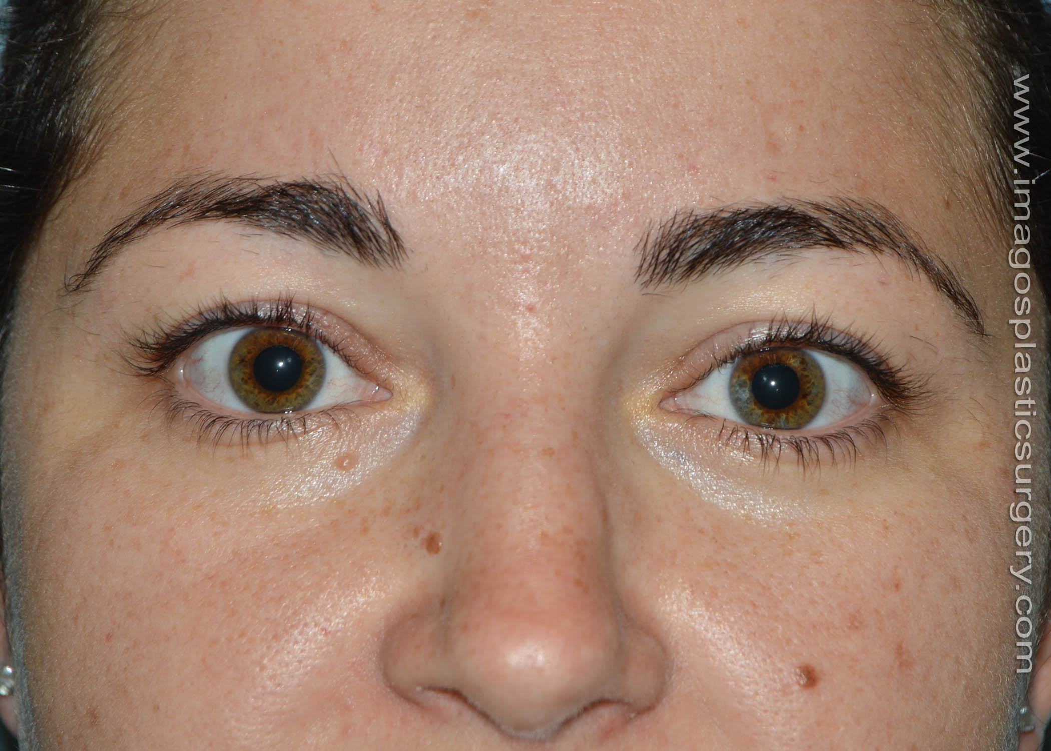 RealSelf-Blepharoplasty-2-Before