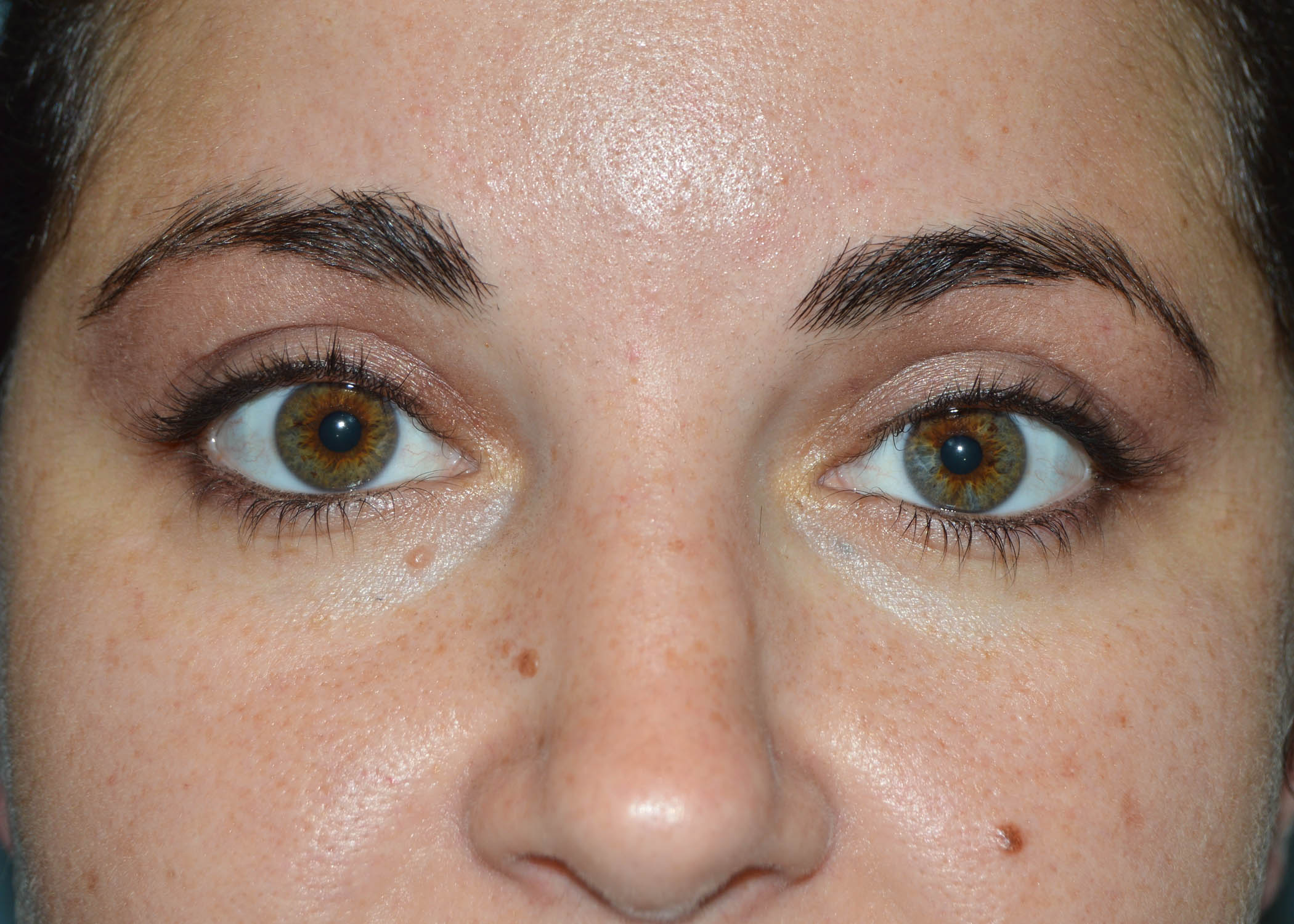 RealSelf-Blepharoplasty-2AAfter