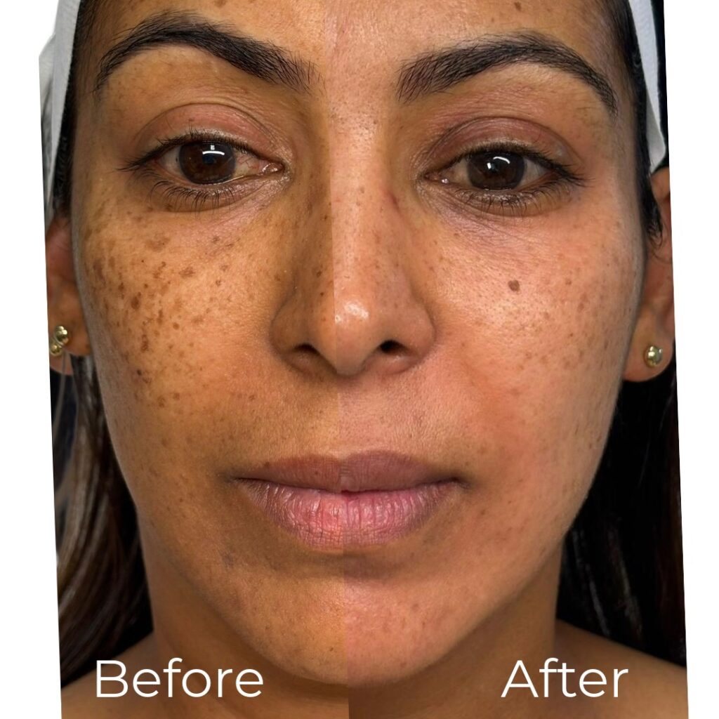 how to remove hyperpigmentation