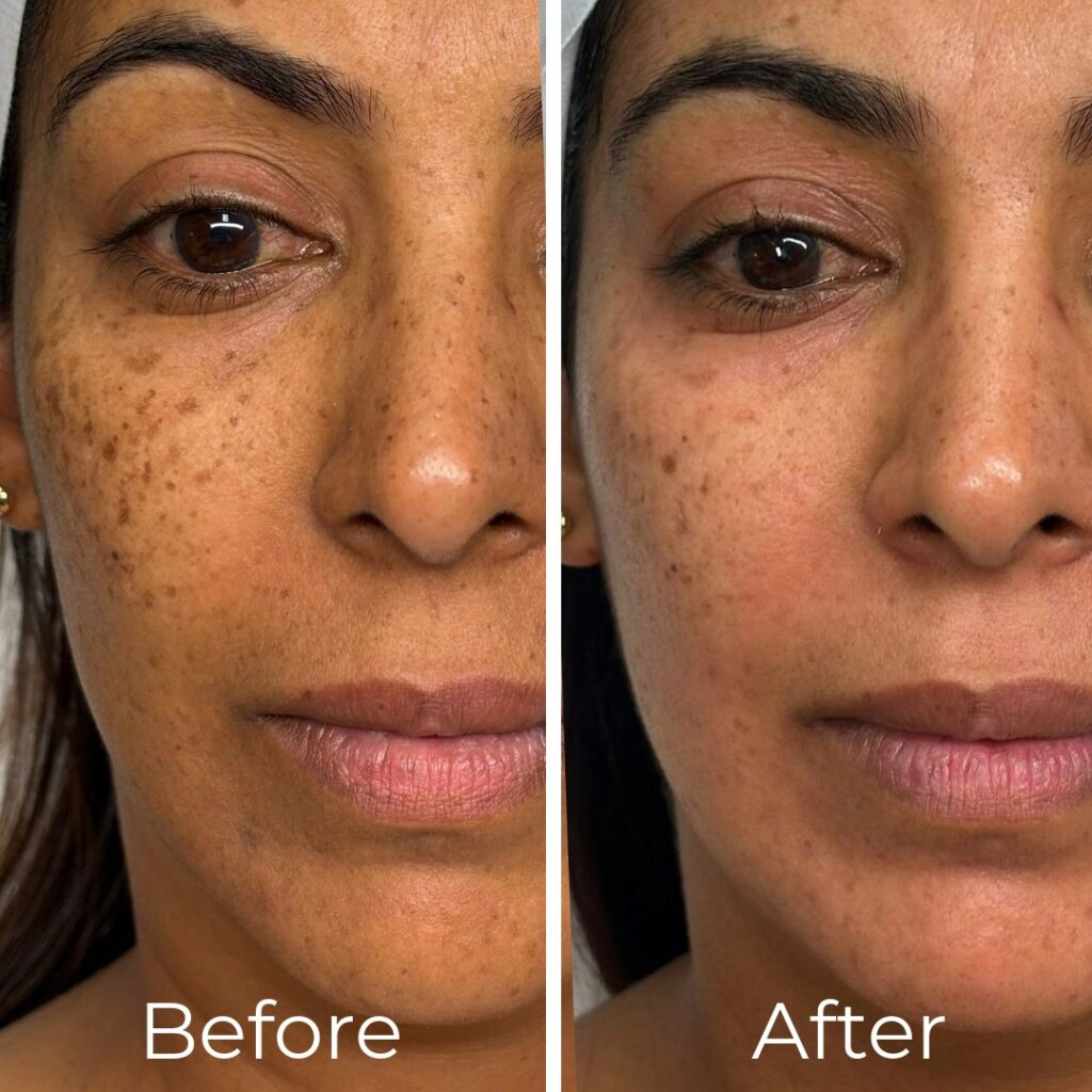 how to remove hyperpigmentation NewMelan